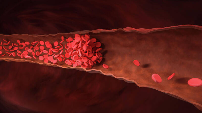 Врач назвала первые признаки оторвавшегося тромба